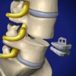 Spinal Disc Replacement